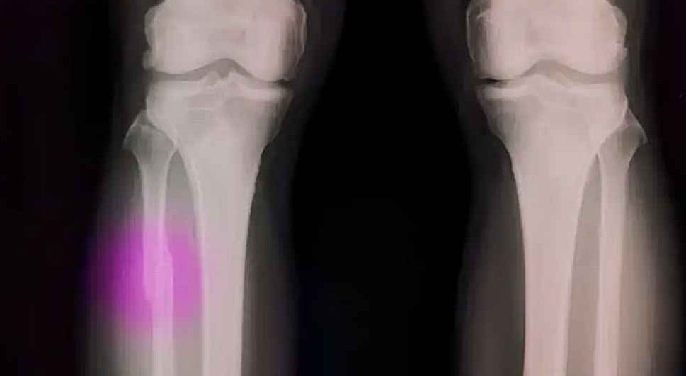 আঠা ‘গ্লু গান’-এ জোড়া লাগবে ভাঙা হাড়